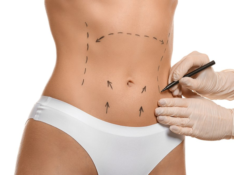 Imagem sobre Abdominoplastia